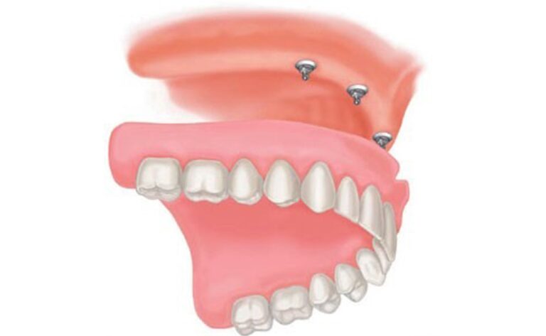 What are Overdentures?